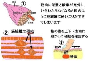 【春日部のやぎはし整体院】春日部で「筋筋膜性腰痛」専門の治療・整体