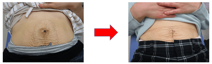 【春日部のやぎはし整体院】産後・腹直筋離開オンライン診療