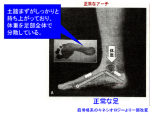 【春日部のやぎはし整体院】ひざの痛みの治療・整体　扁平足を治すことで膝の痛みを劇的に改善！