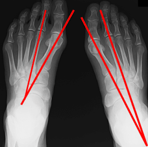 【春日部のやぎはし整体院】ひざの整体　母趾を整える