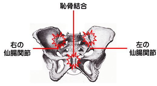 骨盤のイラスト