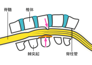 【春日部のやぎはし整体院】春日部で『腰椎椎間板症』専門の治療・整体