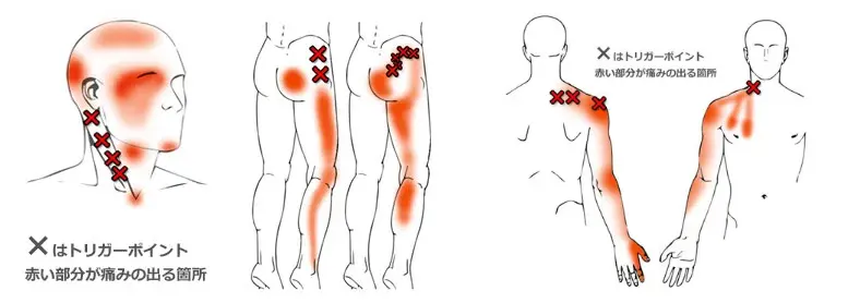 筋肉の異常な収縮を治すマイオセラピー